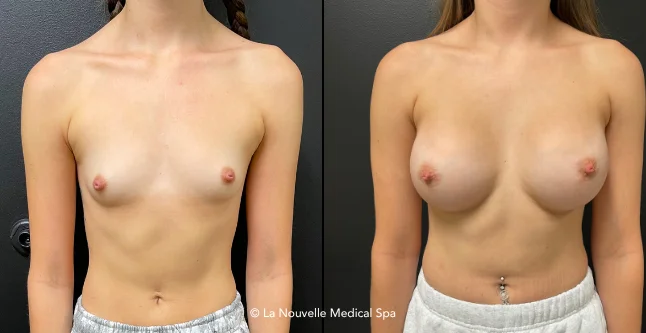 breast augmentation with silicone implants before & after photos, Ventura County, Los Angeles, Thousand Oaks