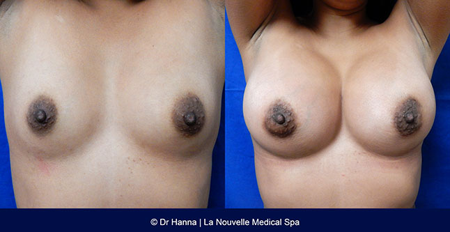 breast augmentation with silicone implants before after photos by dr. Hanna, La Nouvelle Medical Spa, Oxnard, Ventura County, 28 